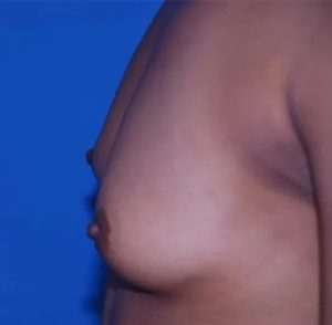 before breast augmentation left side view case 4646 | Crispin Plastic Surgery Atlanta, GA