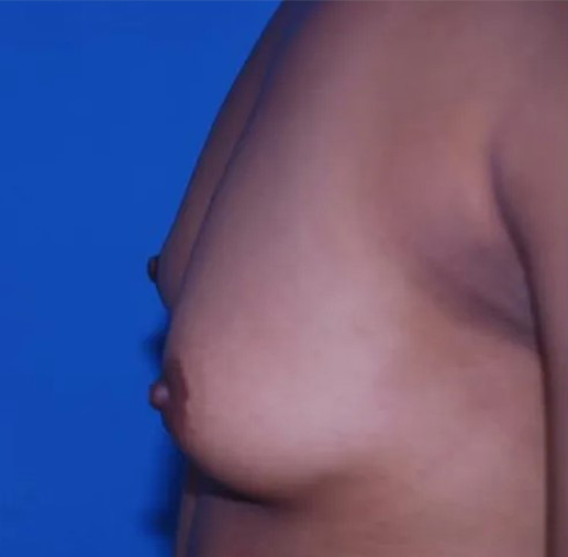 before breast augmentation left side view case 4646 | Crispin Plastic Surgery Atlanta, GA