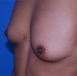 before breast augmentation front left diagonal view case 4646 | Crispin Plastic Surgery Atlanta, GA