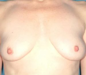before breast augmentation front view case 4654 | Crispin Plastic Surgery Atlanta, GA