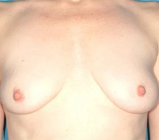 before breast augmentation front view case 4654 | Crispin Plastic Surgery Atlanta, GA
