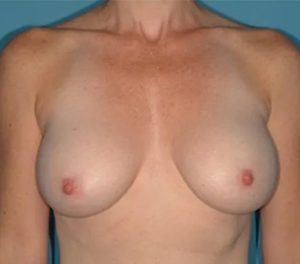 after breast augmentation front view case 4654 | Crispin Plastic Surgery Atlanta, GA
