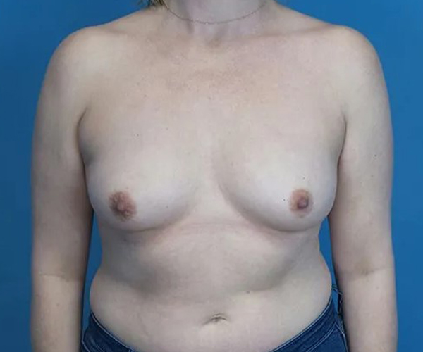 before breast augmentation front view case 4675 | Crispin Plastic Surgery Atlanta, GA