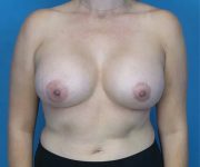 after breast augmentation front view case 4675 | Crispin Plastic Surgery Atlanta, GA