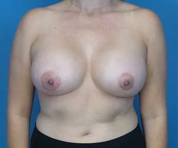 after breast augmentation front view case 4675 | Crispin Plastic Surgery Atlanta, GA