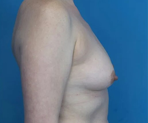 before breast augmentation right side view case 4675 | Crispin Plastic Surgery Atlanta, GA