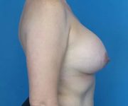 after breast augmentation right side view case 4675 | Crispin Plastic Surgery Atlanta, GA