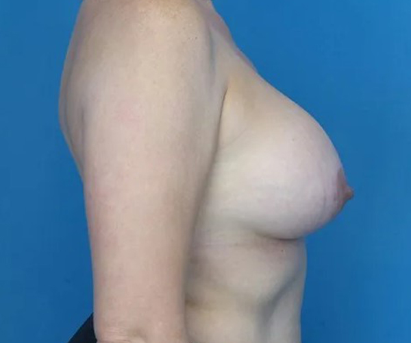 after breast augmentation right side view case 4675 | Crispin Plastic Surgery Atlanta, GA