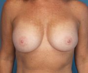 after breast augmentation front view case 4680 | Crispin Plastic Surgery Atlanta, GA