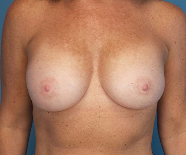 after breast augmentation front view case 4680 | Crispin Plastic Surgery Atlanta, GA
