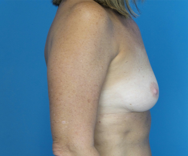 before breast augmentation right side view case 4680 | Crispin Plastic Surgery Atlanta, GA