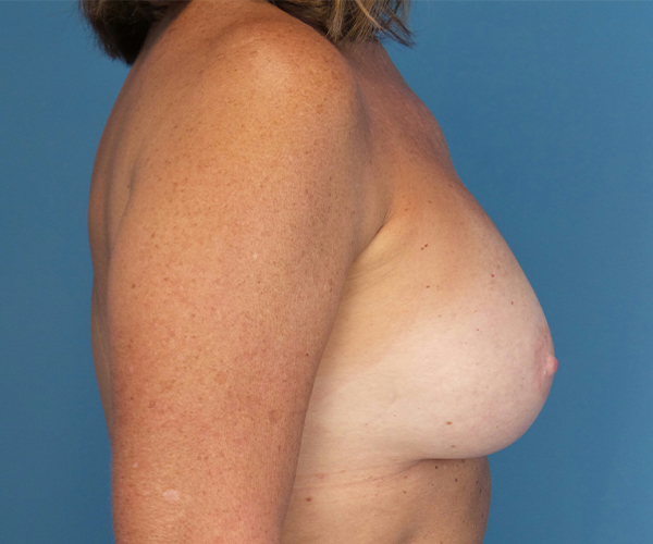 after breast augmentation right side view case 4680 | Crispin Plastic Surgery Atlanta, GA