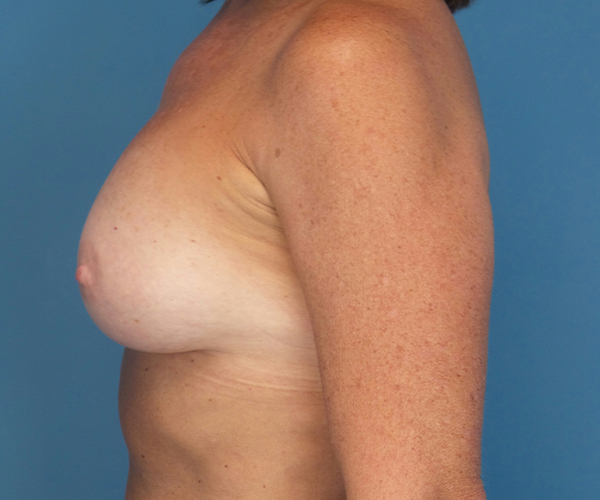 after breast augmentation left side view case 4680 | Crispin Plastic Surgery Atlanta, GA
