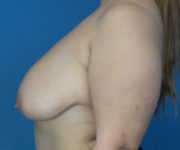 before breast lift left side view case 2764