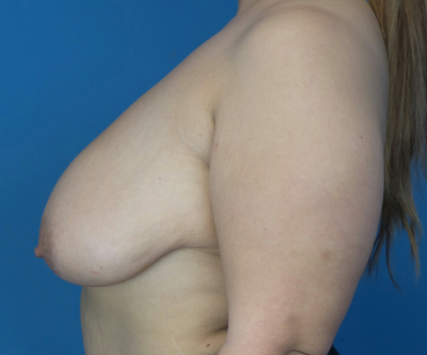before breast lift left side view case 2764