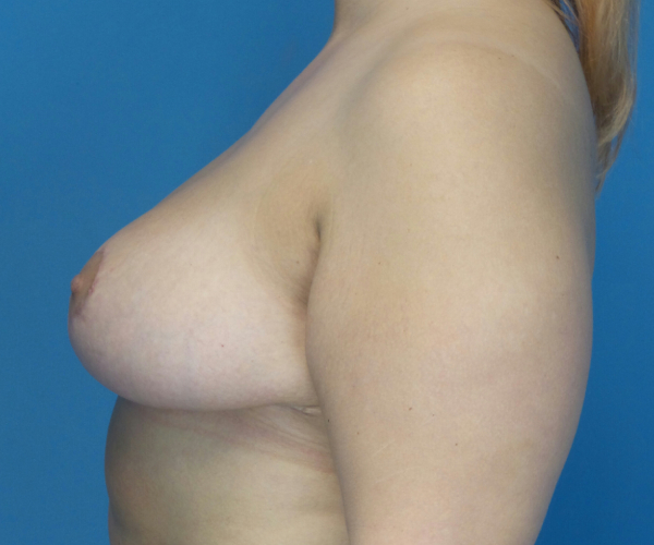 after breast lift left side view case 2764