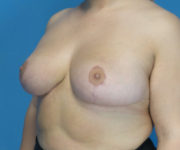 after breast lift left angled view case 2764