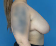 before breast lift right side view case 2764