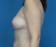 after breast lift left side view case 2893