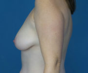 before breast lift left side view case 2893
