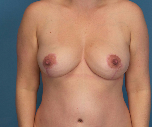 after breast lift front view case 2900