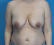 before breast lift front view case 2900