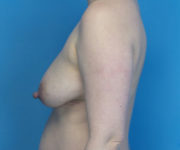 before breast lift left side view case 2900