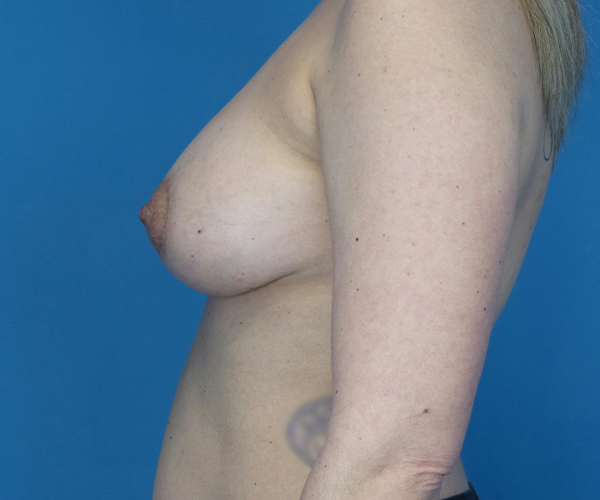 after breast lift with augmentation left side view case 2169 | Crispin Plastic Surgery