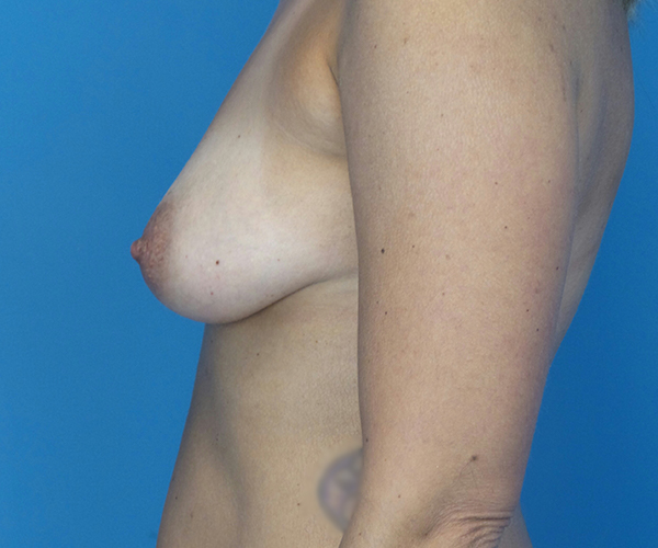 before breast lift with augmentation left side view case 2169 | Crispin Plastic Surgery