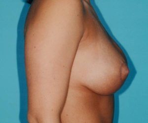 after breast lift with augmentation right side view case 3175