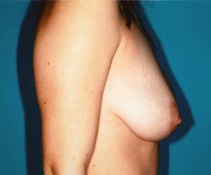 before breast lift with augmentation right side view case 3175