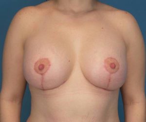 after breast lift with augmentation front view case 3196