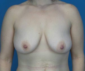 before breast lift with augmentation front view case 3196