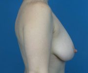 before breast lift with augmentation right side view case 3196