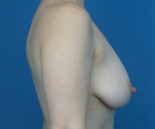 before breast lift with augmentation right side view case 3196