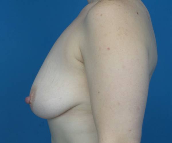 before breast lift with augmentation left side view case 3196