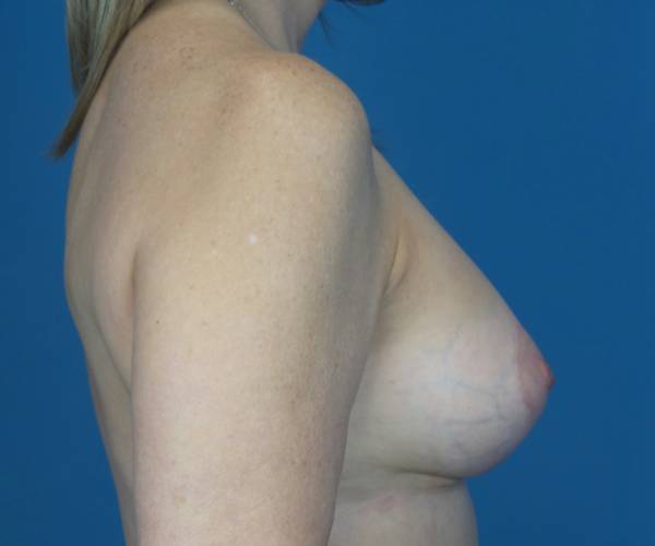 after breast lift with augmentation right side view case 3207