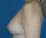 after breast lift with augmentation left side view case 3207