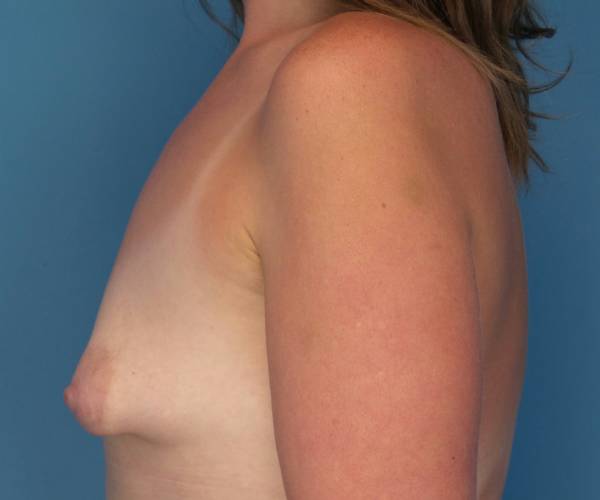 before breast lift with augmentation left side view case 3216