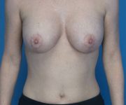 after breast lift with augmentation front view case 3232