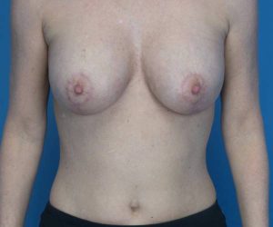 after breast lift with augmentation front view case 3232