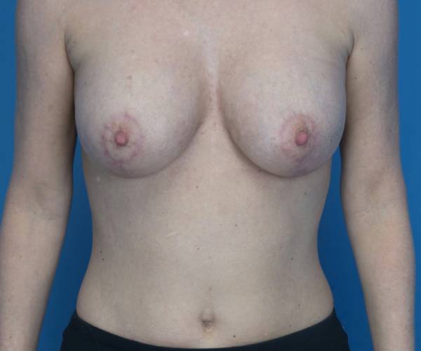 after breast lift with augmentation front view case 3232