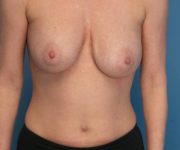 before breast lift with augmentation front view case 3232