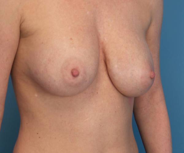 before breast lift with augmentation right angled view case 3232