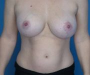 after breast lift with augmentation front view case 3294