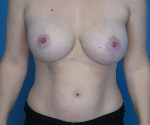 after breast lift with augmentation front view case 3294