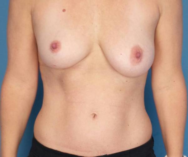before breast lift with augmentation front view case 3294