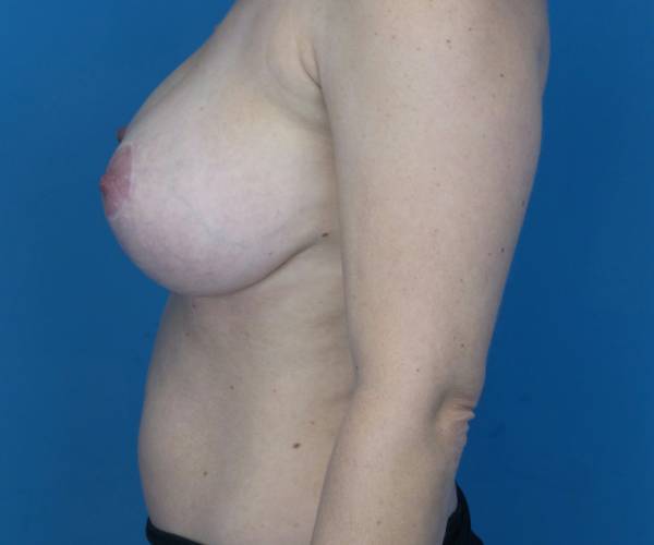 after breast lift with augmentation left side view case 3294
