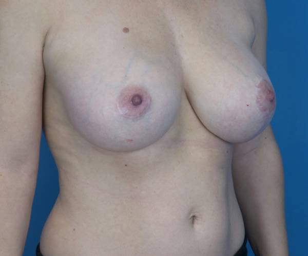 after breast lift with augmentation right angled view case 3294