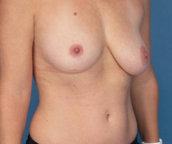 before breast lift with augmentation right angled view case 3294